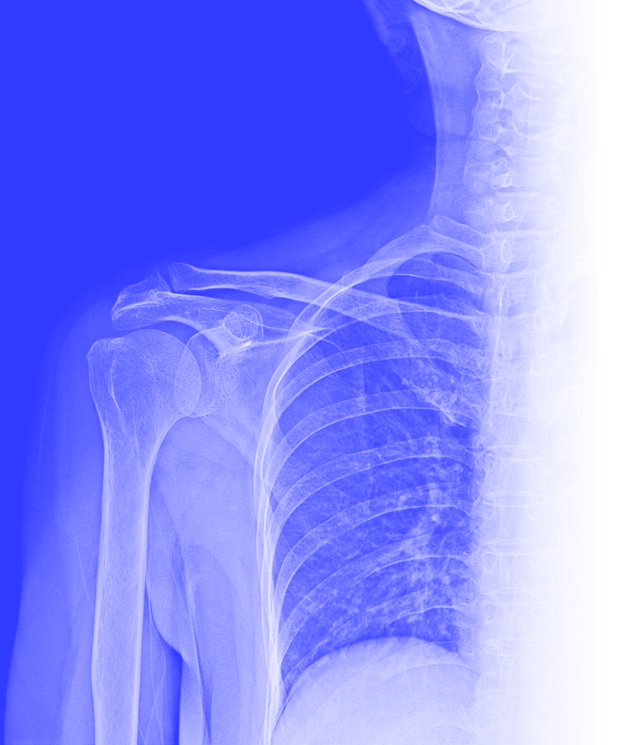 Collarbone X-Ray